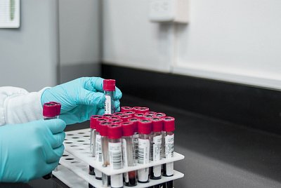 Pokud se obáváte nákazy hepatitidou A, dojděte si raději na testy